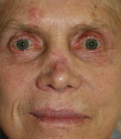 Feel Beautiful - 87 yr old nose revision - Before Photo